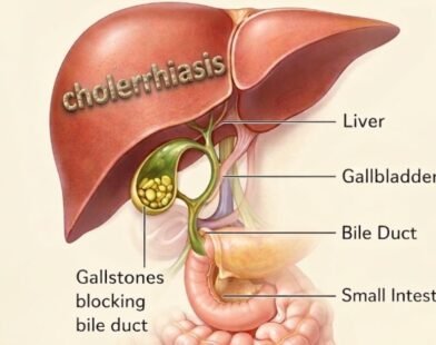 Cholerhiasis: Gallstones Causes & Treatment